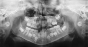 Dental Radiographs (X-Rays) - Pediatric Dentistry and Orthodontics in Burbank, CA