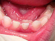 Baby Teeth - Pediatric Dentistry and Orthodontics in Burbank, CA