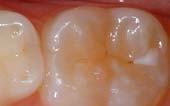 Sealant-Before - Pediatric Dentistry and Orthodontics in Burbank, CA