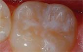 Sealant-After - Pediatric Dentistry and Orthodontics in Burbank, CA